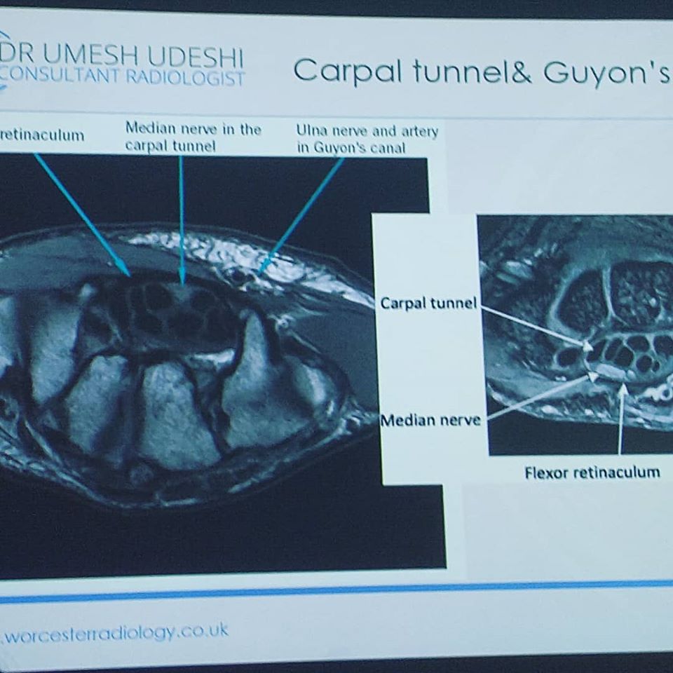 MRI Scan of Carpal Tunnel Syndrome - Umesh Udeshi, Cheltenham Cobalt Centre